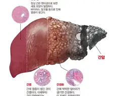 점점 죽어가는 간.jpg