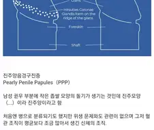 성인남성 30%가 고추, 귀두에 가지고 있는 것.jpg