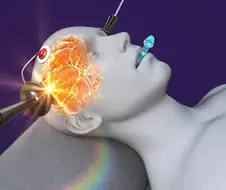 전기충격치료가 우울증에 직빵이라던데
