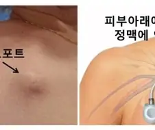 부작용 꽤나 크지만 그래도 사용하는 주사법