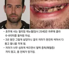3년간 콜라먹은 남자