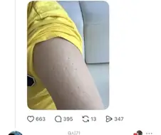나보다 불주사 자국 심한 사람 못 봄.jpg