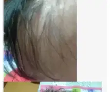 탈모가 온 중3 학생