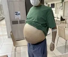 맥주를 10년간 매일 3L씩 마신 일본 남자