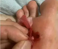 약혐) 티눈 재발 방지하는 방법