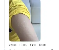 불주사 자국 레전드.JPG