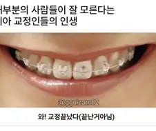 교정 안한 사람들은 모른다는 치아 교정인의 인생.jpg