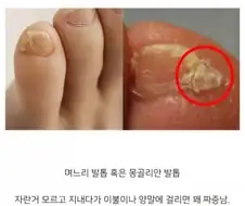 새끼발가락에 생기면 매우 거슬리는 것.jpg