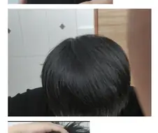 모발이식에 천만원 투자한 38살