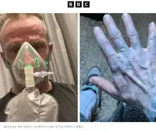 피부가 파래져서 응급실에 실려간 영국인