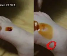 올바른 포비돈 요오드 용액 사용법