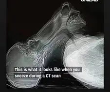 CT찍을때 재채기 하면 안되는 이유