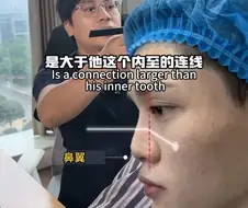 SNS에서 뽑은 남자 코 성형 레전드 비포에프터