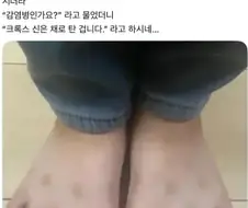 여름에 흔히들 걸린다는 피부병 증상