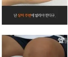 빨간약 바르는 잘못된 방법