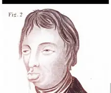 1847년 의학서에 실린, 자위 많이하면 이렇게 되버린다 예 초상화.jpg