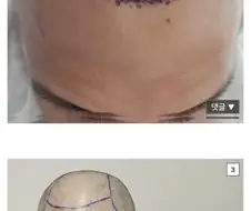 터키 모발이식 8천모 후기.jpg