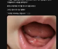 사탕 먹다가 잇몸에 박힌 아기.jpg