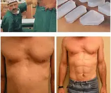 인공 복근.jpg
