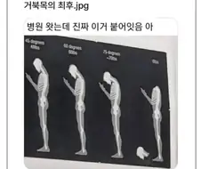 거북목의 최후.jpg