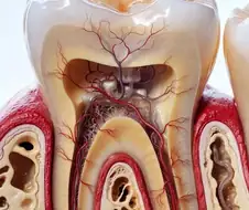 이빨 뽑으면 잇몸 붓고 피 계속 나는 이유.jpg