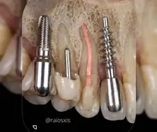 임플란트 잇몸 약하면 못하는 이유.jpg