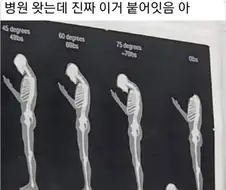 거북목의 최후