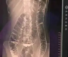 만성변비의 X레이 사진
