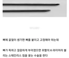 뼈 안 부러져본 사람들이 의외로 모르고 있는 사실들.jpg