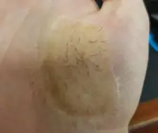 피부이식의 심각한 문제점