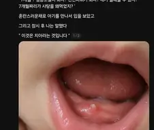 아기 잇몸에 사탕이 박혀 응급실에 감