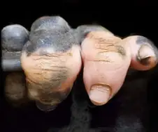 백반증 걸린 고릴라의 손