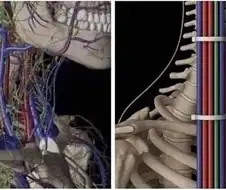 꼬인선 정리 초고수