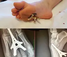 (혐) 발바닥에 박힌 에펠탑