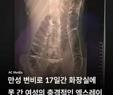 만성 변비로 17일간 화장실 못 간 여성의 몸 엑스레이샷